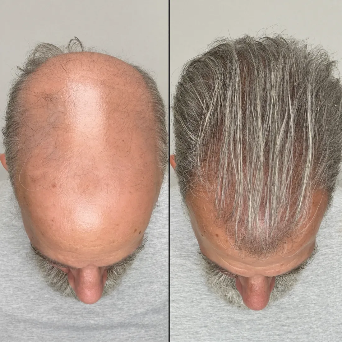 Antes y después: densidad en cabello cano tras 90 días con RedLume